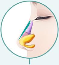 C-8 S-line Nose Surgery method image 2