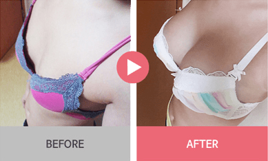 B-1 Water drop Endoscope Breast Surgery-before after image 2