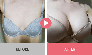 B-1 Water drop Endoscope Breast Surgery-before after image 4