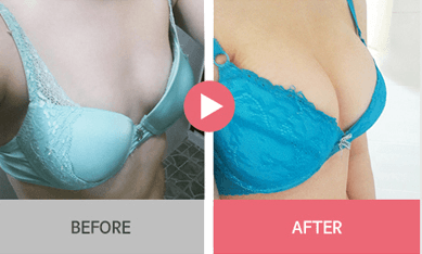 B-1 Water drop Endoscope Breast Surgery-before after image 5