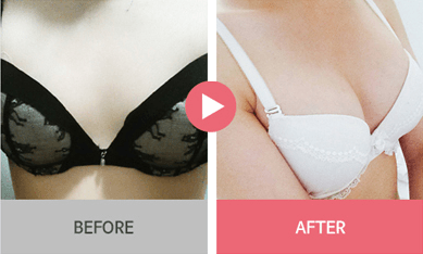 B-1 Water drop Endoscope Breast Surgery-before after image 6
