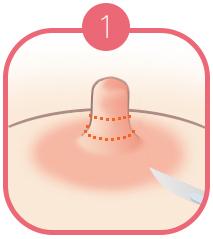 B-7 Nipple Surgery-case of long nipple image 1
