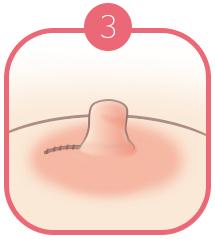 B-7 Nipple Surgery-non severe image 3