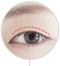 D-4 Ptosis Correction dual incision image 1