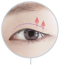D-4 Ptosis Correction full incision image 3