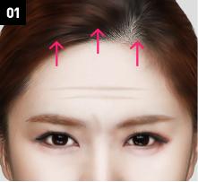 D-6 Upper-Lower forehead lifting image 1