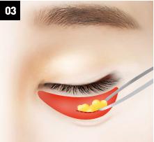 D-6 lower blepharoplasty Relocation of the fat-image 3