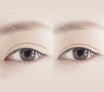 D-7 Eye Revision Surgery why you need image 3