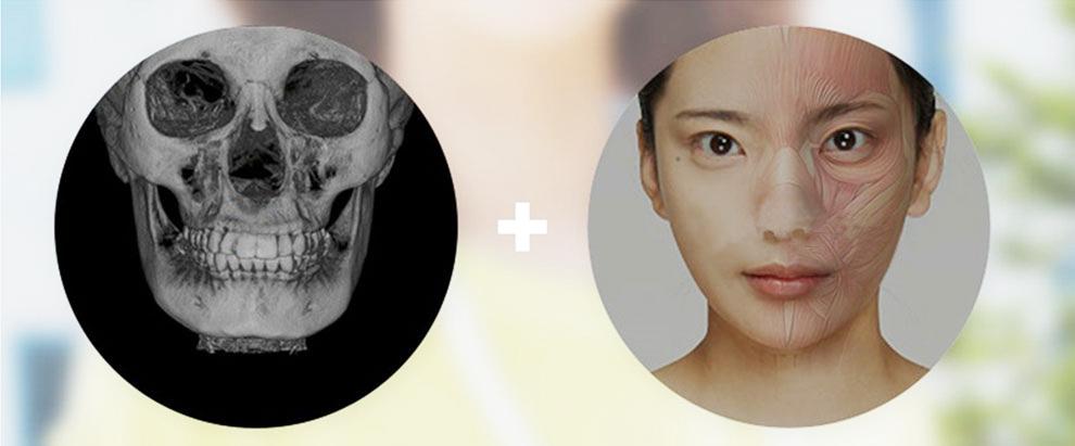 E-1 Facial Bone Contouring image 3