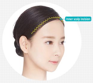 E-5-2 Forehead Expansion features 1