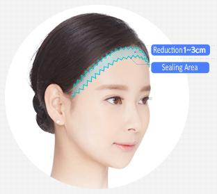 E-5-2 Forehead Reduction features 1