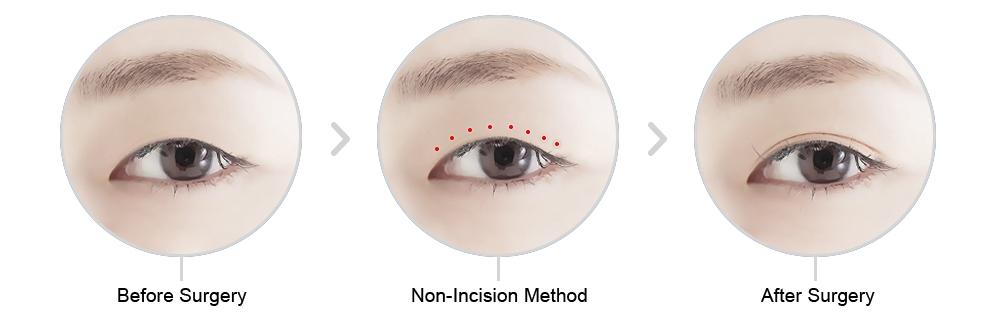 Eyelid Suture Non-incisional Double Eyelid Surgery double eyelid surgery in...