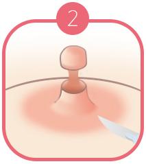 B-7 Nipple Surgery-case of long nipple image 2