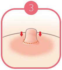 B-7 Nipple Surgery-case of long nipple image 3