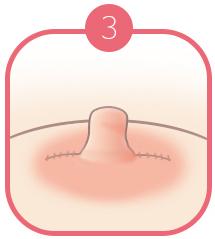B-7 Nipple Surgery-severe case image 3