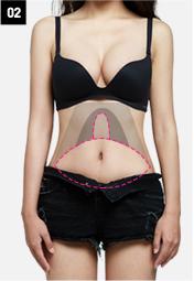 H-4 Abdomen Liposuction-High abdominal  image 2