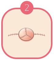 Making the Nipple and the Areola_image 2