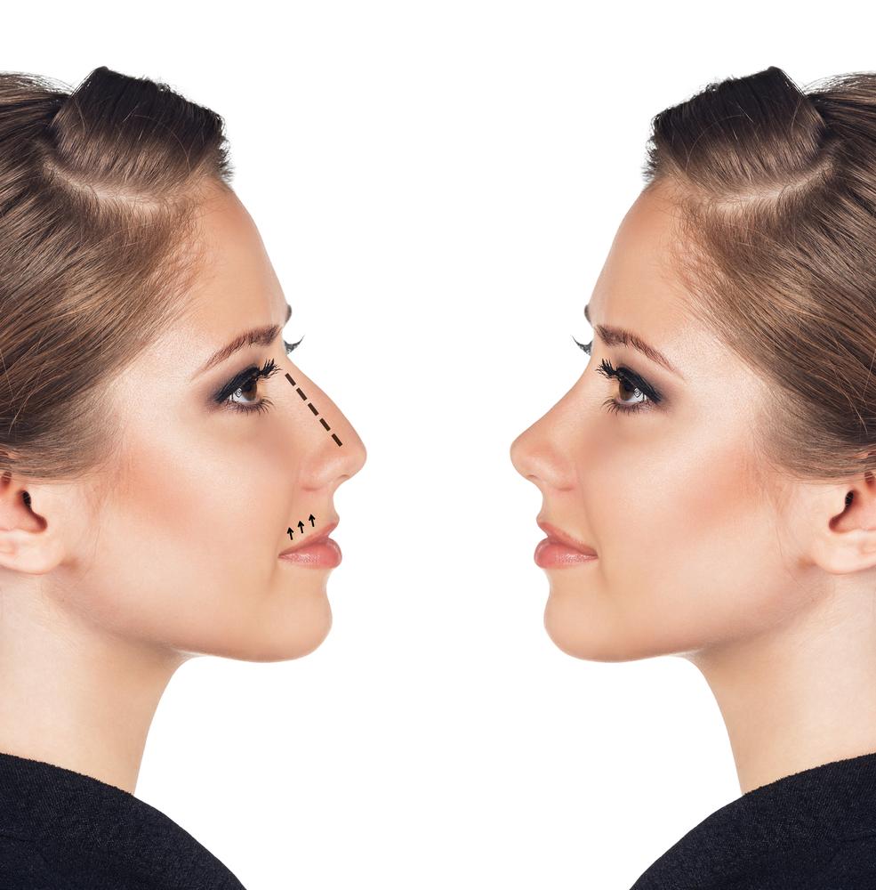 Why Rhinoplasty is Very Famous