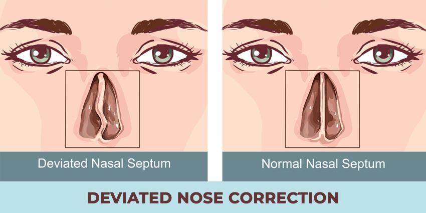 Deviated Nose Correction For Achieving A Perfect Nose