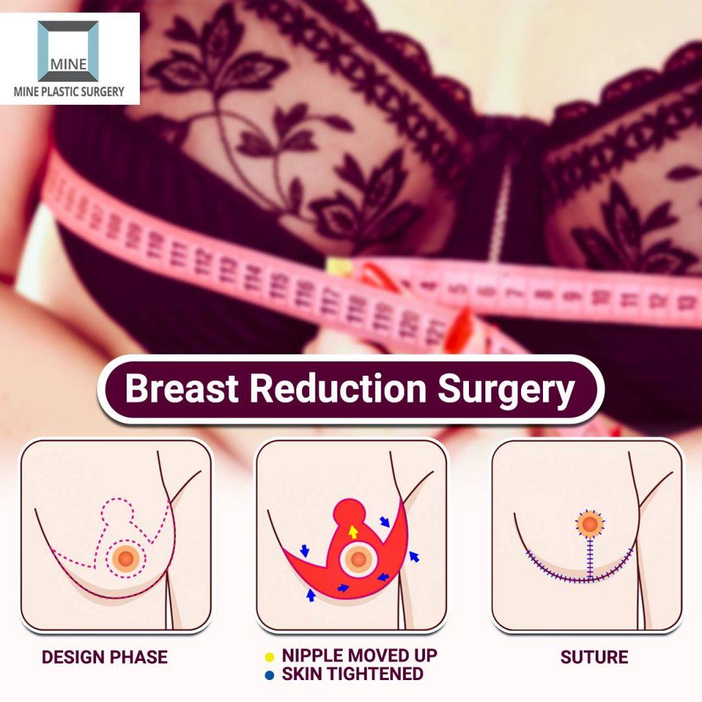 Breast reduction surgery in Korea – Good Methods can make you comfortable