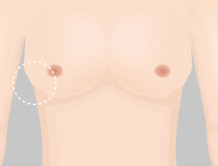 Illustration of Korea breast revision case due to capsular contracture.
