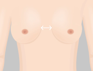 Illustration of Korean breast revision case the breast being too close or too apart.
