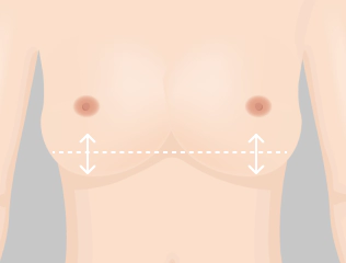 Illustration of Korean breast revision case when the implant has moved positions.
