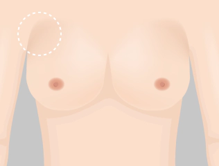 Illustration of Korean breast revision case when the implant has to much upper space.