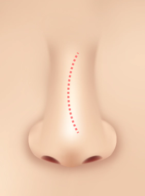 Deviated Septum in a S curved shape.