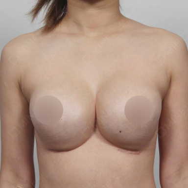Real case where the breast are too close to each other before Korean breast revision surgery.