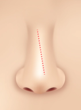 Deviated Septum in a diagonal line.