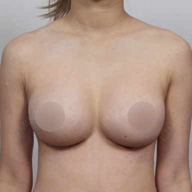 Breasts that have cleavage line in between each other after Korean breast revision surgery.