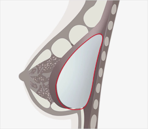 Normal breast capsule that does not need Korean breast revision.
