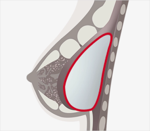 Illustration of breast implant that is surrounded by thick capsule in need of Korean breast revision surgery.