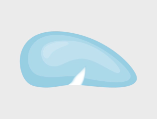 Illustration of Korean breast revision case when the implant has worn down or teared.