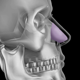 Septal cartilage used in cartilage autologous rhinoplasty.