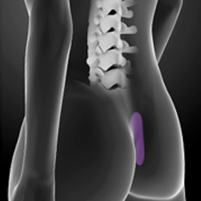 Dermis graft used in cartilage autologous rhinoplasty.