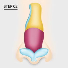 Correcting deviated septum by adding cartilage.