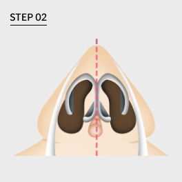 Severely deviated septum is corrected through osteotomy.