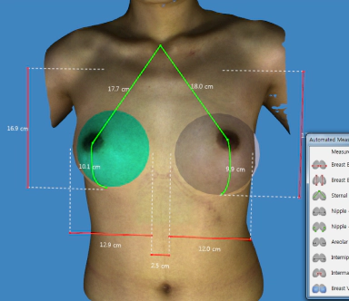 Breast 3D machine result to check size for Korean fat transfer breast augmentation.