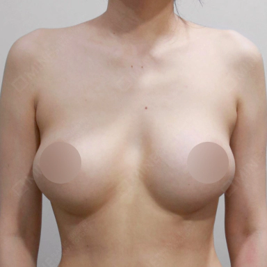Real capsular contracture case before Korean breast revision surgery.