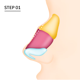 Dorsal hump nose with droopy tip.