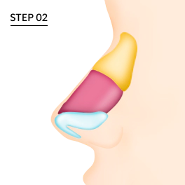 Dorsal hump nose after grinding the hump away.