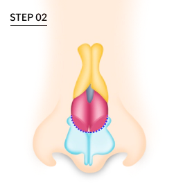Nose with high dorsal hump after osteotomy correction.
