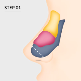 Long nose when the septal cartilage is long.