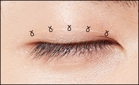 Male double eyelid fixation points.