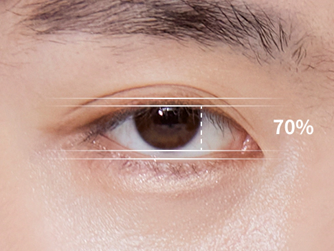 Male eyes that need ptosis correction.