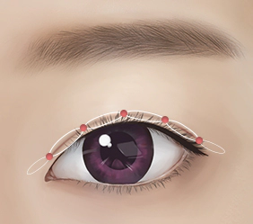 Male double eyelid suture points for ptosis correction.