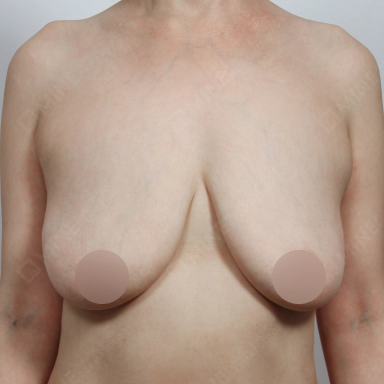 Korean breast reduction before photo showing sagging breasts with volume and asymmetry.
