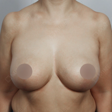 Korean breast reduction after photo showing firmer, higher positioned breasts with natural contour.